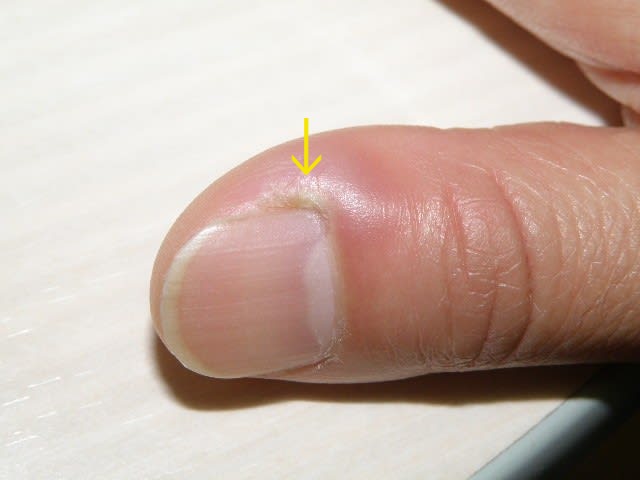 爪 の 周り が 腫れる