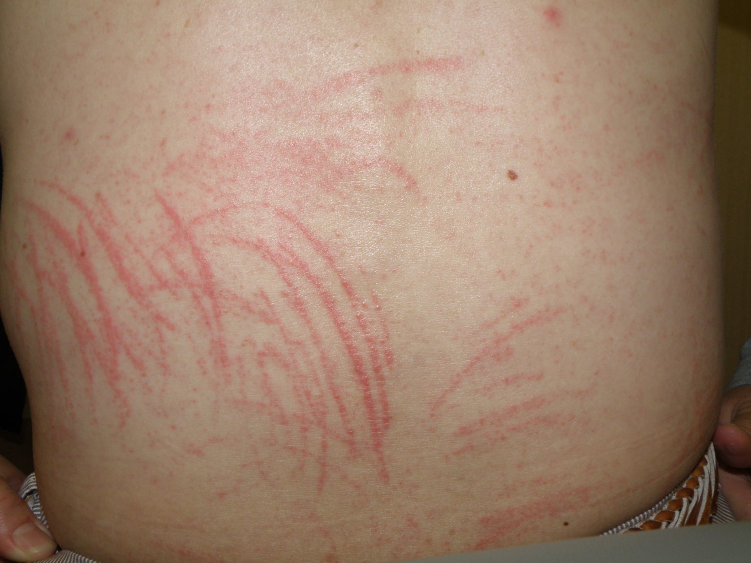 疱疹状皮膚炎にはどのような治療法がありますか?