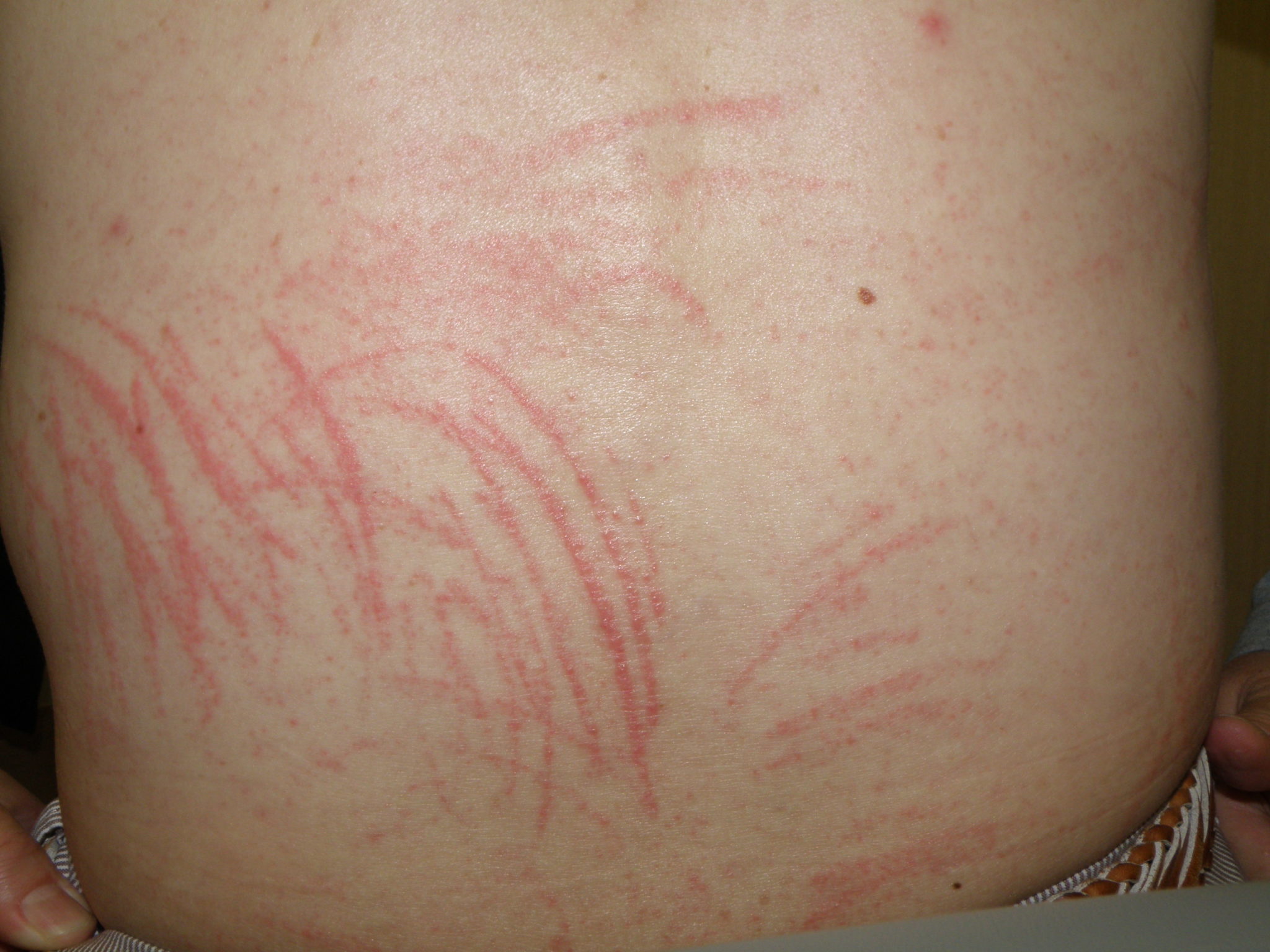 他に皮膚のかゆみを引き起こすものは何ですか?