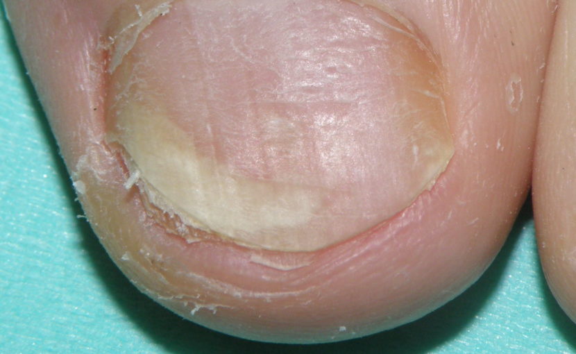 爪白癬 爪水虫 のネイリン 内服治療 のホームページを作りました 橋本クリニック ゆめタウン呉 呉市 皮膚科