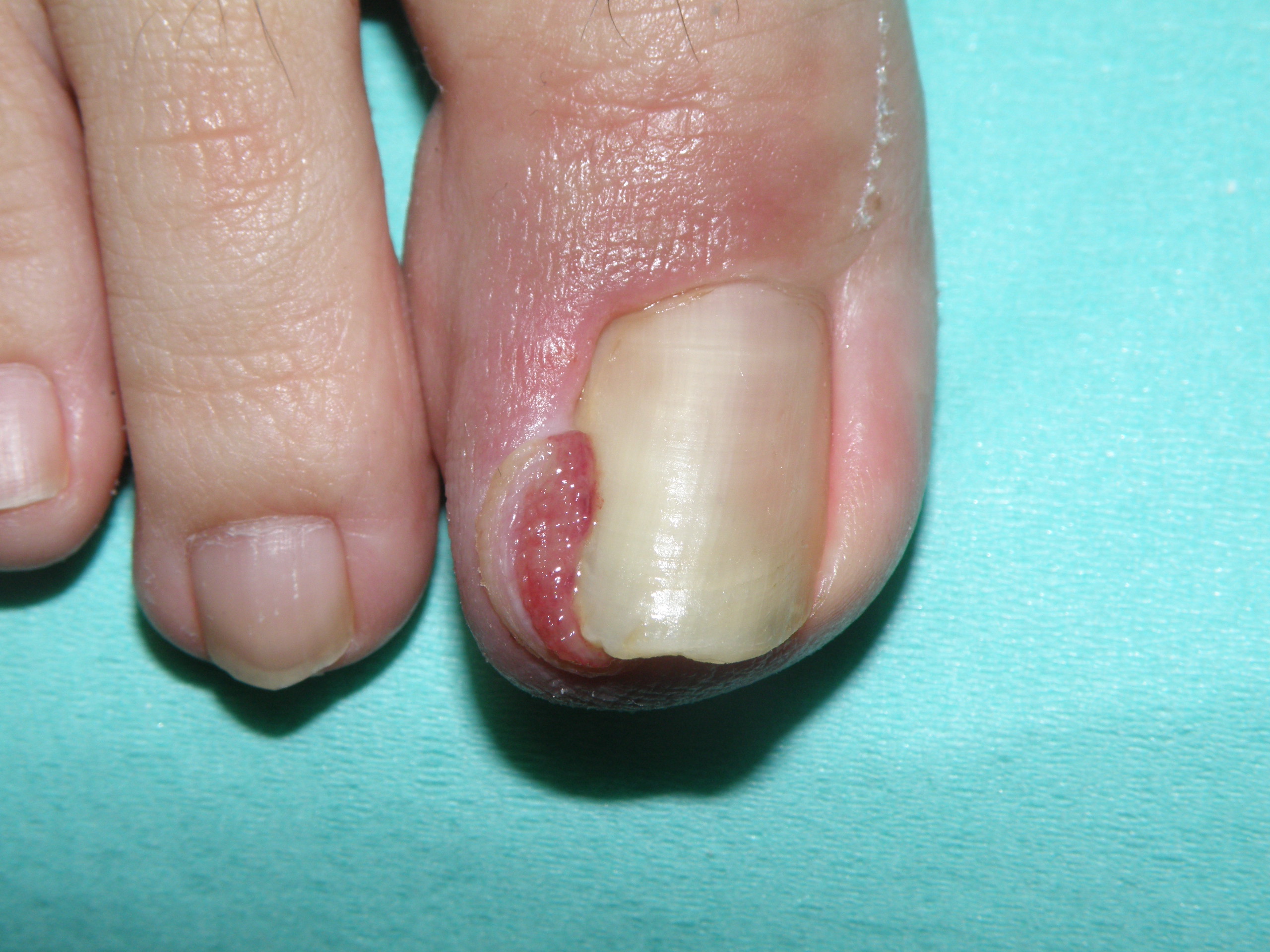 右足 の 親指 の 爪 が 痛い