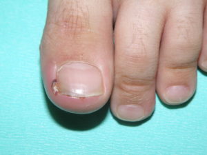 爪のまわりが腫れて赤くて痛いとき 陥入爪 の治療 橋本クリニック ゆめタウン呉 呉市 皮膚科