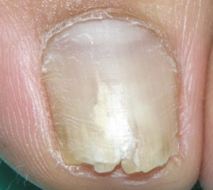 爪が白いのに水虫ではない 爪甲剥離症 橋本クリニック ゆめタウン呉 呉市 皮膚科