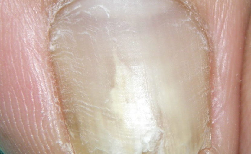 爪が白いのに水虫ではない 爪甲剥離症 橋本クリニック ゆめタウン呉 呉市 皮膚科
