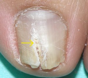 爪白癬ではなくて爪が白く浮いているとき 爪甲剥離症 の診断と治療 橋本クリニック ゆめタウン呉 呉市 皮膚科