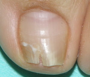 爪白癬ではなくて爪が白く浮いているとき 爪甲剥離症 の診断と治療 橋本クリニック ゆめタウン呉 呉市 皮膚科