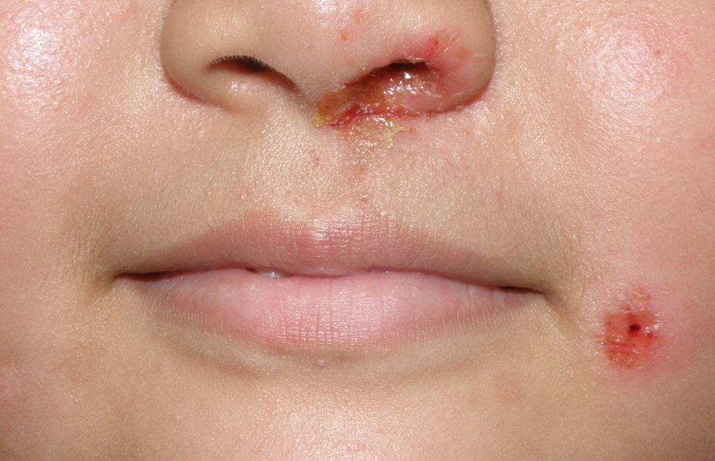 他の種類のブドウ球菌感染症の症状