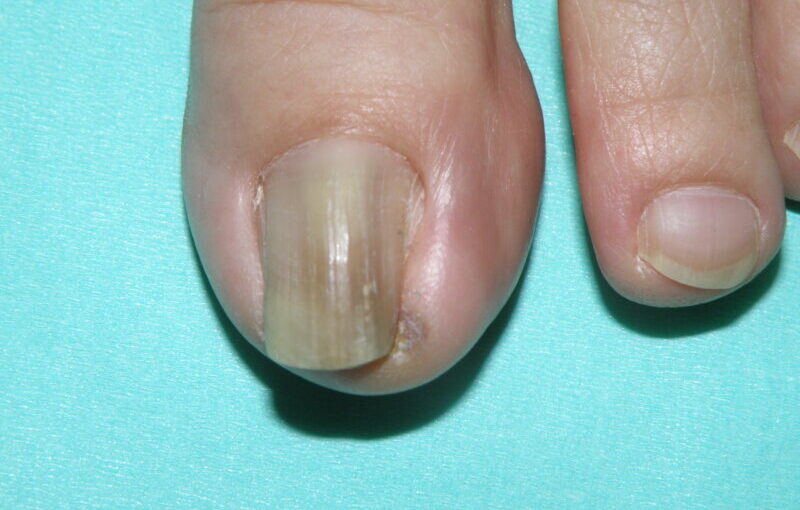 医師はヘルペス性ひそひそ性をどのように診断しますか?